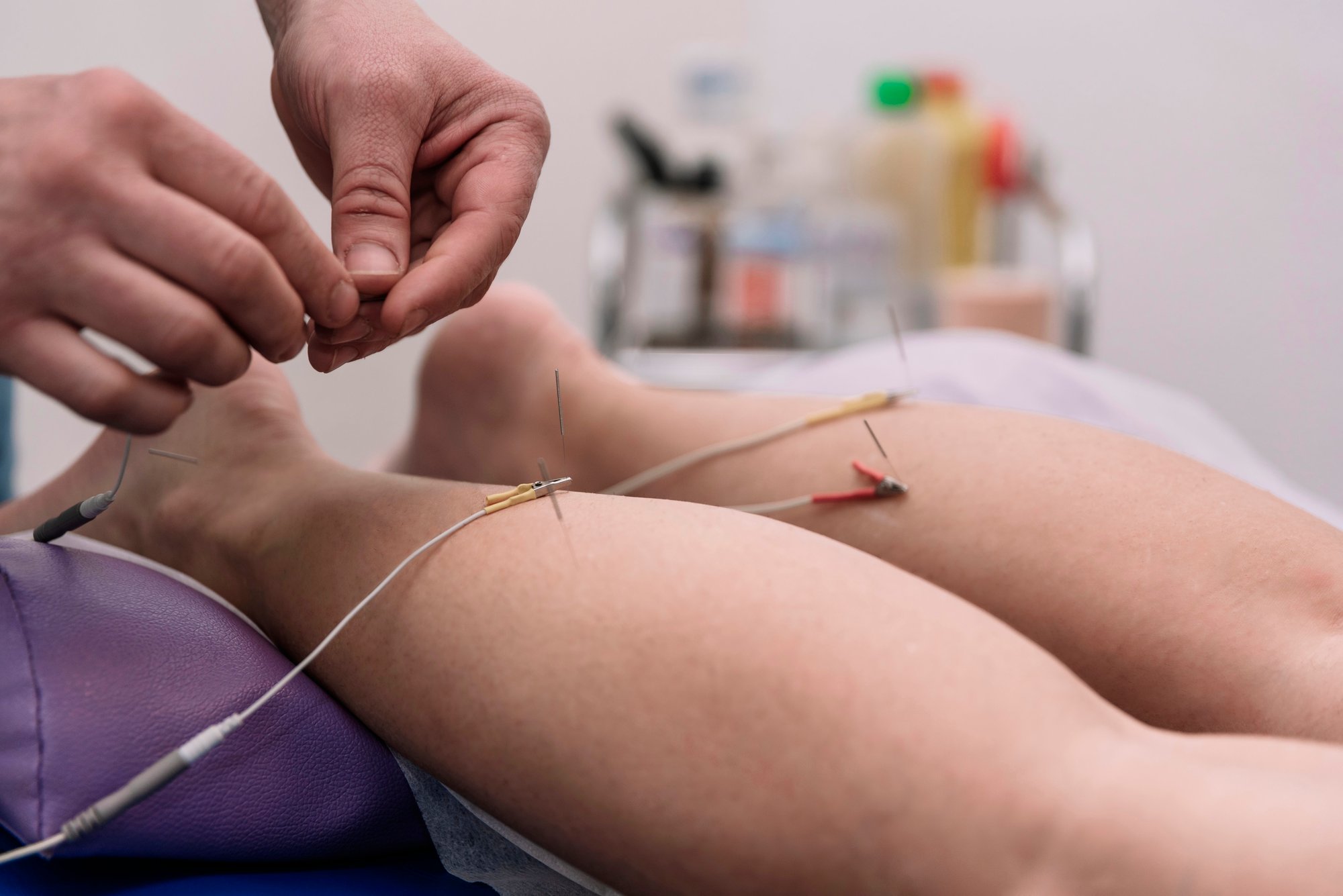 electrical stimulation dry needling