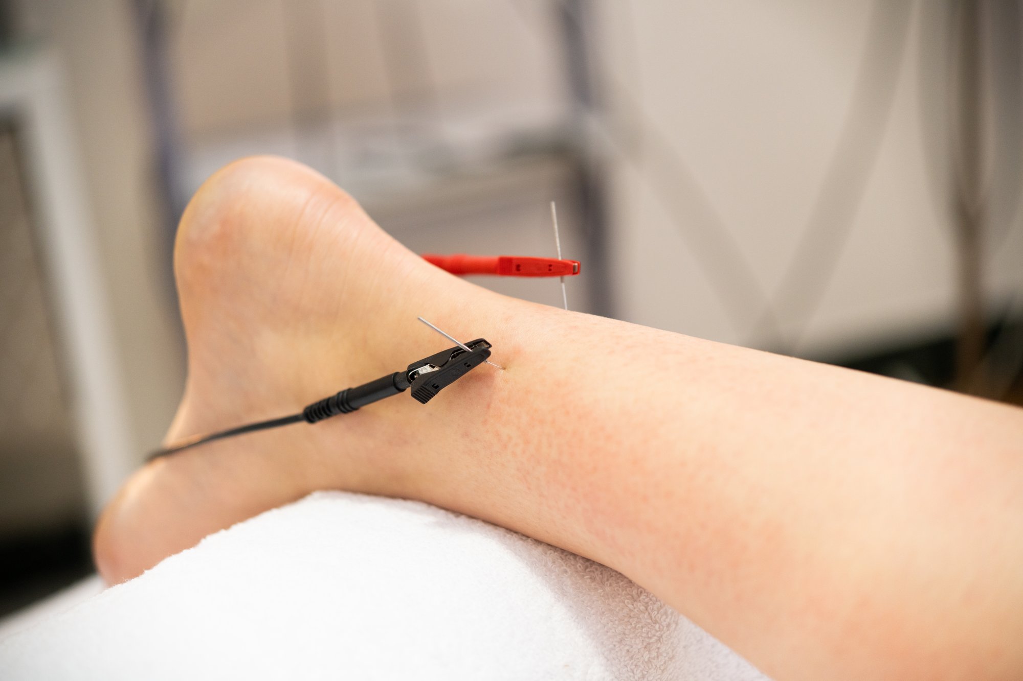 Electric stimulation dry needling on patient achilles